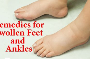 10 Natural Remedies For Swollen Feet And Ankles |  Ways to Reduce EDEMA Naturally at Home |