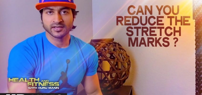 Can you reduce the Stretch Marks? | Health and Fitness Tips | Guru Mann