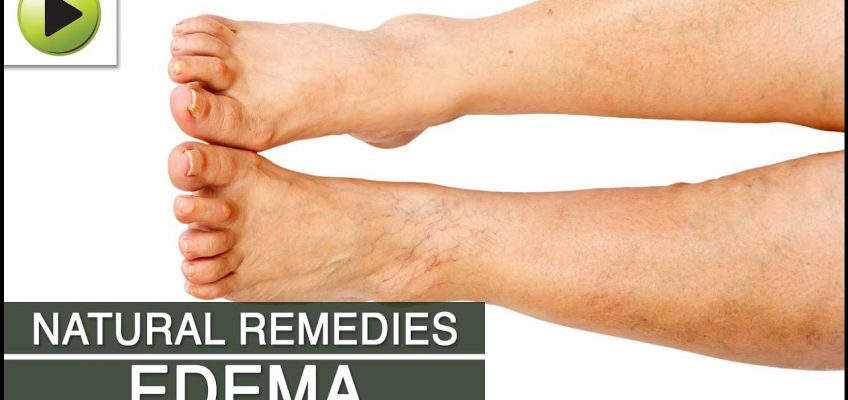 Edema – Natural Ayurvedic Home Remedies