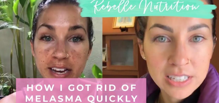 HOW I HEALED MY MELASMA/DARK SPOTS QUICKLY – REBELLE NUTRITION