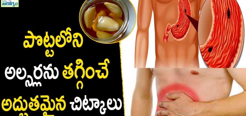 Stomach Ulcer Treatment At Home – Natural Home Remedies || mana Arogyam