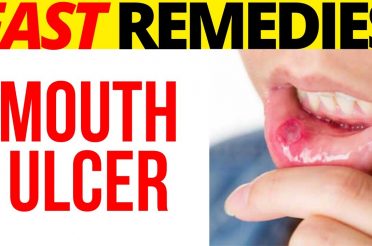 🌼 🌼 7 Superb Home Remedies To Get Rid Of Mouth Ulcers