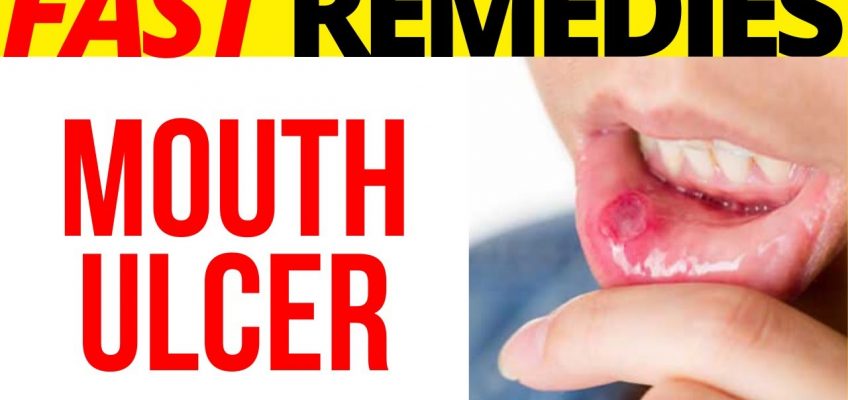 🌼 🌼 7 Superb Home Remedies To Get Rid Of Mouth Ulcers