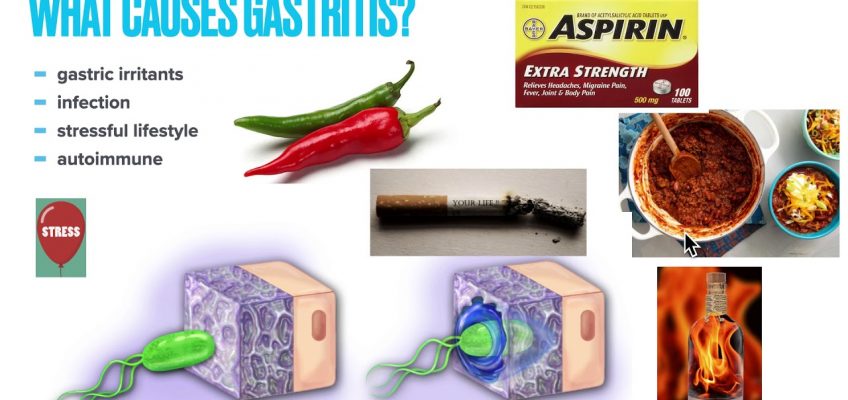 Chronic Gastritis: Causes, Symptoms, Treatment,  Prevention, Why treatment fails and How to fix it!!