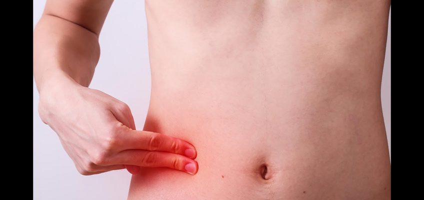 HOW TO PREVENT AND DEAL WITH APPENDICITIS NATURALLY