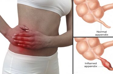 How to Get Rid of a Stomach Ache.
