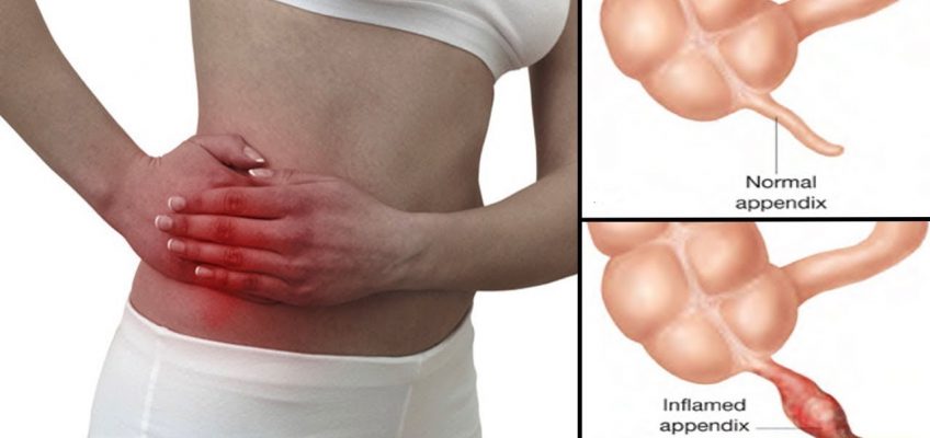 How to Get Rid of a Stomach Ache.