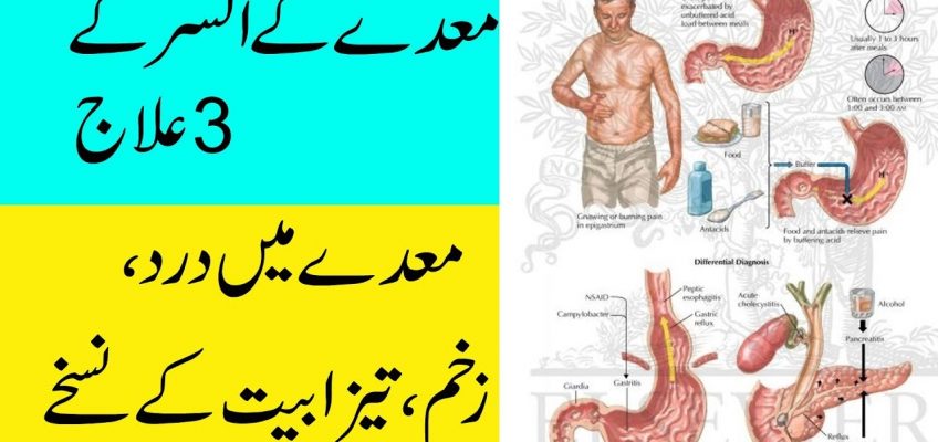 How To Cure Stomach Ulcer Home Remedies In Urdu/Hindi | Maday Ka Ilaj