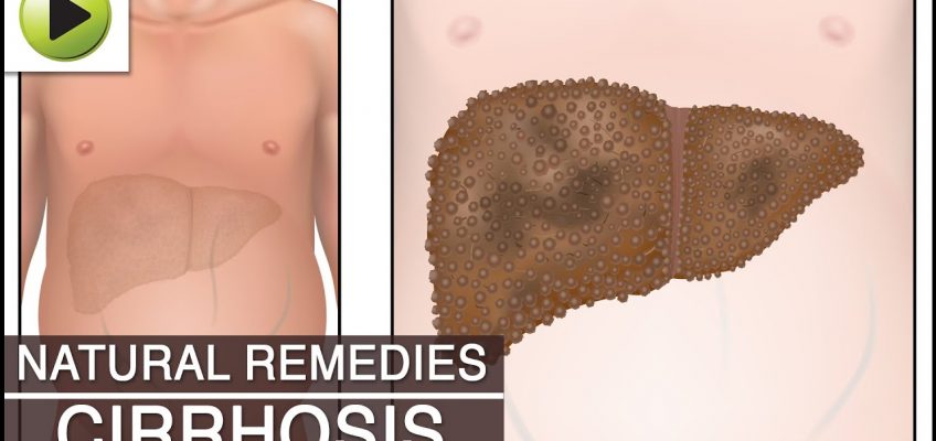 Liver Cirrhosis – Natural Ayurvedic Home Remedies