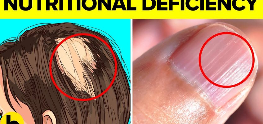 14 Signs That Indicate You Have A Nutritional Deficiency
