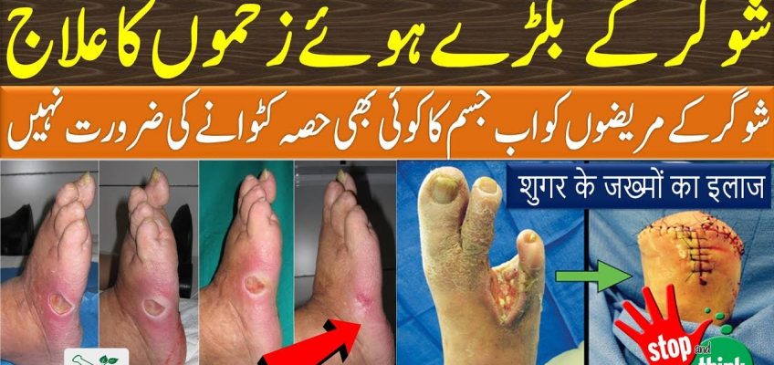 Diabetes Cure Home Remedy | Sugar Ke Zakham Ka Ilaj | Stomach Problems Solutions