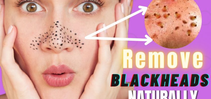 How To Get Rid of Blackheads Naturally | 3 Home Remedies to Make Blackheads Vanish