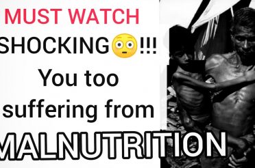 Malnutrition ( Nutrition Deficiency) #%??