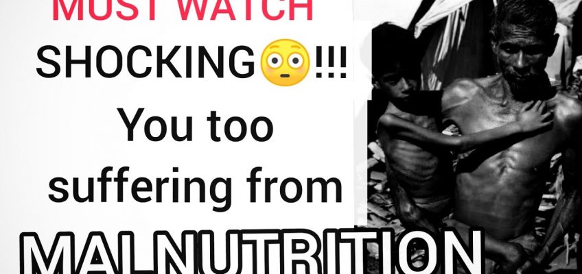 Malnutrition ( Nutrition Deficiency) #%??