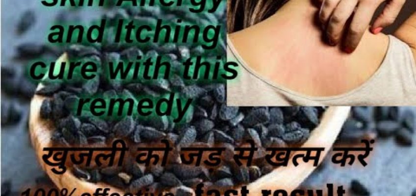 Skin Allergy and Itching/त्वचा रोग और खुजली/ Permanent solution with this home remedy