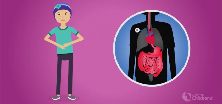 Total Parenteral Nutrition During Cancer Treatment | Cincinnati Children's