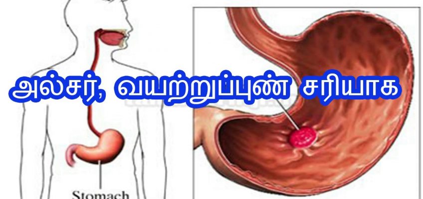 அல்சர், வயற்றுப்புண் சரியாக stomach ulcer home remedy in tamil| paarambariya maruthuvam for ulcer