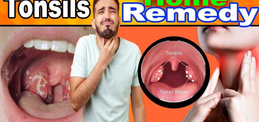 தொண்டை வலி எளிய வீட்டு மருத்துவம் – டான்சில் குணமடைய | Tonsils Home remedy | Simple remedy