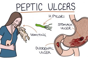 Understanding Stomach and Duodenal Ulcers